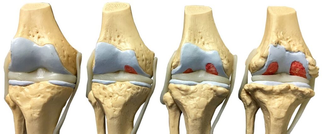 A close-up of a model of knee joint Description automatically generated