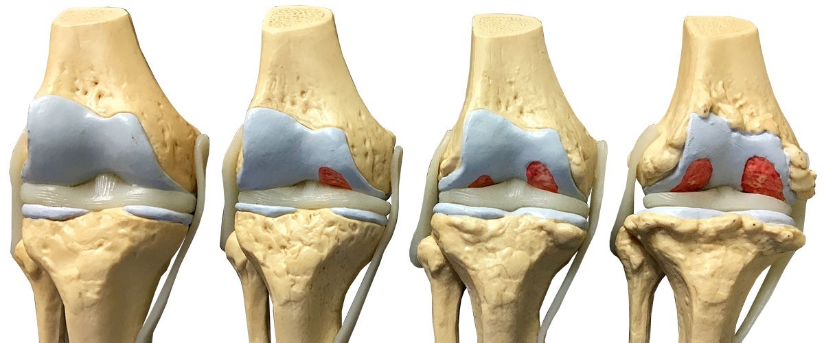 A close-up of a model of knee joint

Description automatically generated