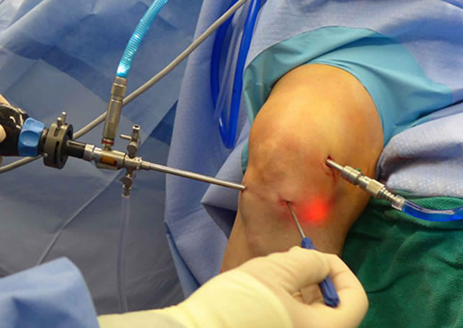 A person performing surgery on a knee

Description automatically generated